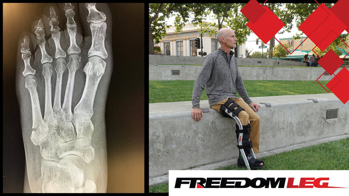 Jones Fracture and Recovery